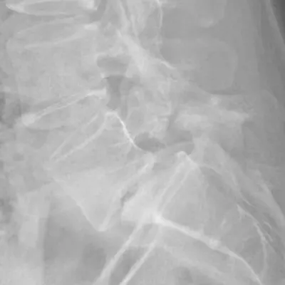 X-RAY: IV