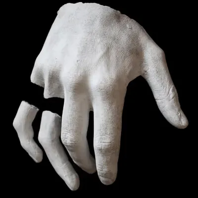 Broken fingers