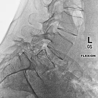 X-RAY: V