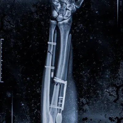 My Recovery